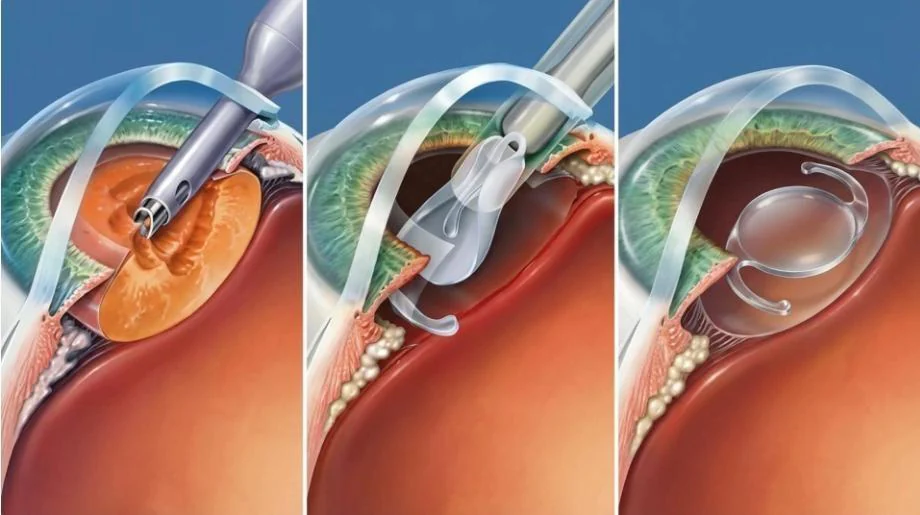 Cross-section illustration of micro-incision cataract surgery: the clouded lens is broken up and removed, a folded intraocular lens is inserted, and the new lens unfolds into position.